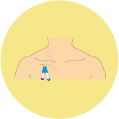 留置カテーテル